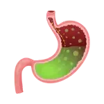 Acidity and Acid Reflux