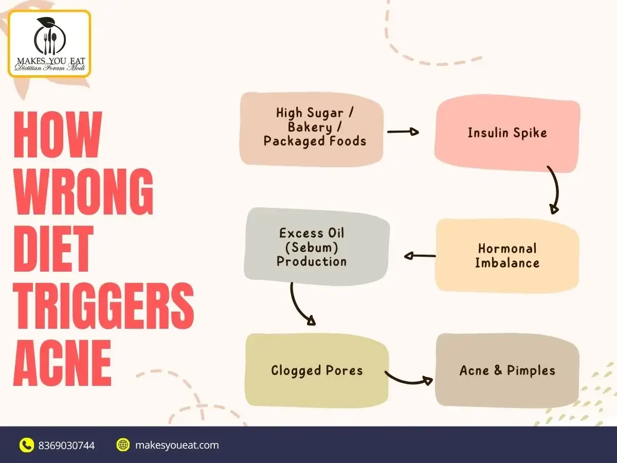 How wrong diet triggers acne - Dt. Foram Modi explains